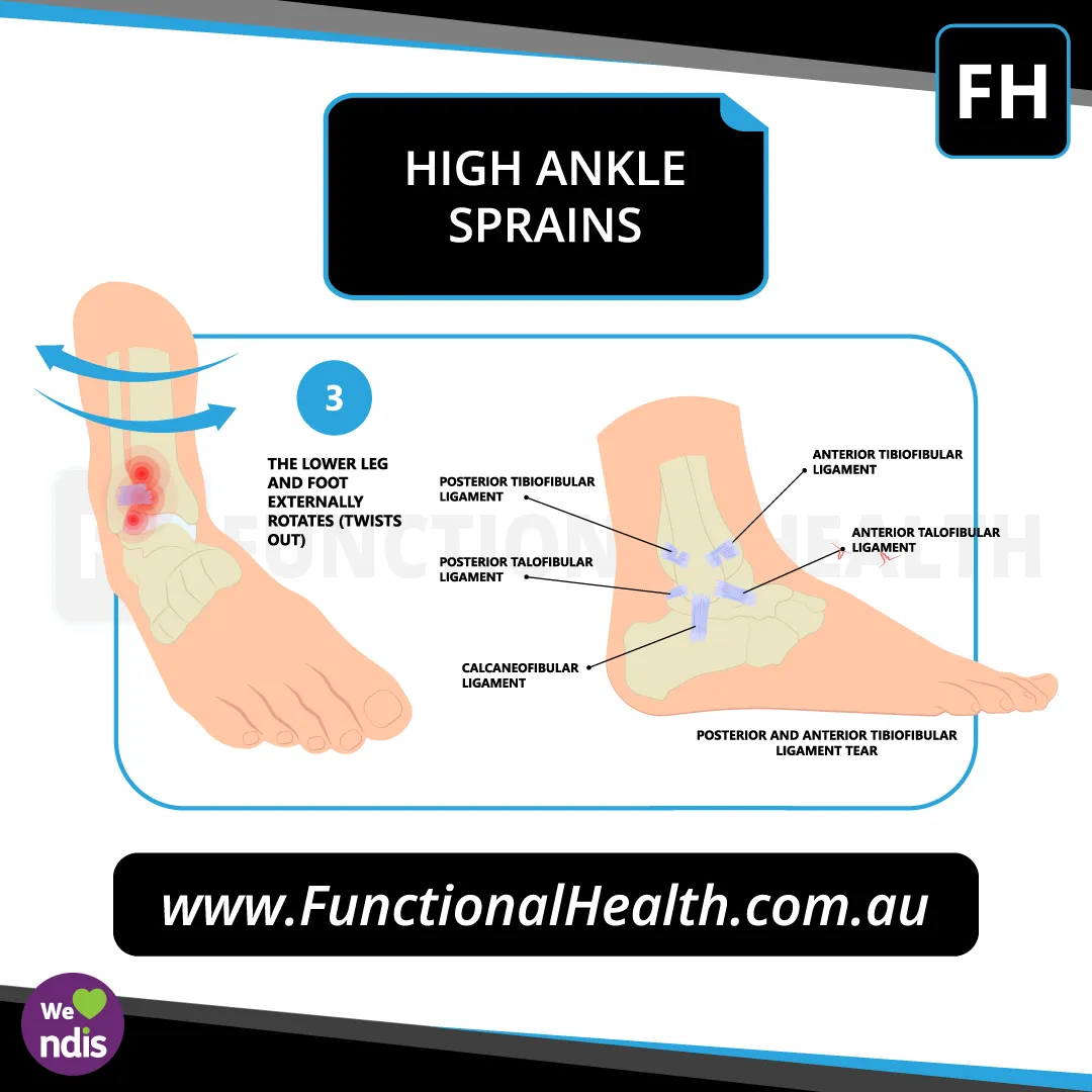 Eversion Ankle Sprain - Functional Health Physiotherapy Gold Coast